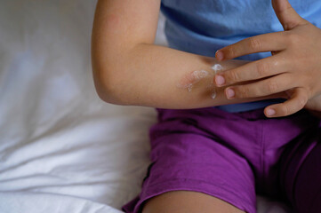 Itching on hands kids with redness rash. Cause of itchy skin include dermatitis (eczema), dry skin, burned, food,drug allergies, insect bites. Health care concept.