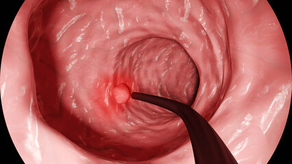Colon Polyp Detected During Colonoscopy