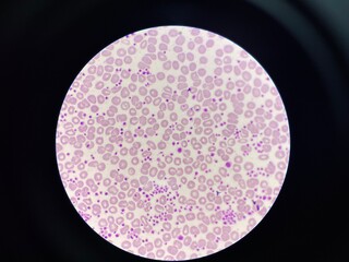 This image shows a blood smear under a microscope, revealing an abnormally high number of platelets. The platelets appear as small, irregularly shaped cell fragments scattered throughout the field. 