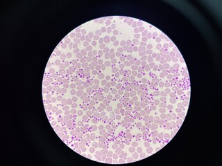 This image shows a blood smear under a microscope, revealing an abnormally high number of platelets. The platelets appear as small, irregularly shaped cell fragments scattered throughout the field. 