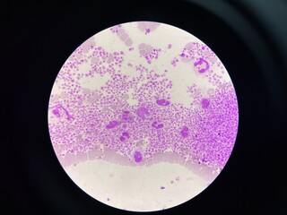This image shows a blood smear under a microscope, revealing an abnormally high number of...