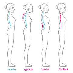 Back posture problems medical diagram. Young woman with kyphosis, lordosis and flat back, healthy spine comparison. Infographic vector illustration.