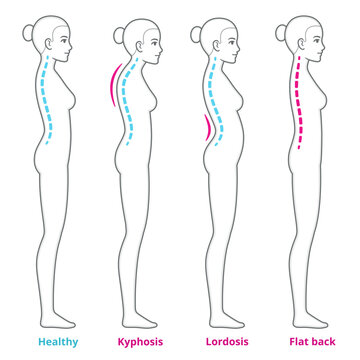 Back posture problems medical diagram. Young woman with kyphosis, lordosis and flat back, healthy spine comparison. Infographic vector illustration.
