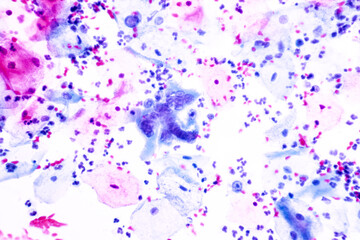 Genital herpes infection by the herpes simplex virus (HSV) of the genitals.Ground glass appearance criteria for pap smear slide cytology and pathology.Human cell medical concept.