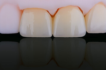 High-quality six dental crowns made of zirconium for fixation to the teeth of upper jaw.
