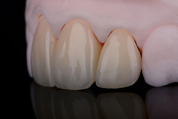 High-quality dental single crowns made of zirconia for fixation to frontal teeth of upper jaw © gorynvd
