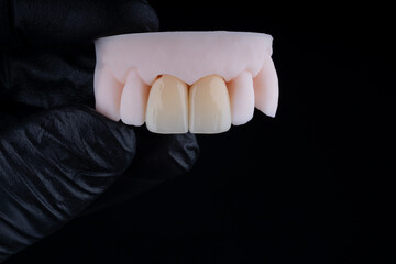 High-quality dental single crowns made of zirconium for fixation to the frontal teeth of upper jaw. © gorynvd