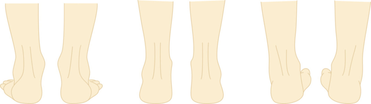 正常な足と外反足・内反足のイラストセット