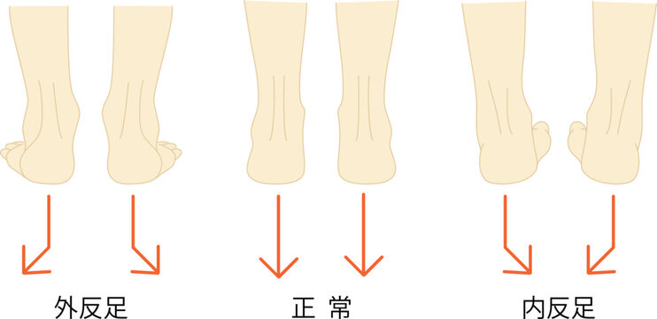 正常な足と外反足・内反足のイラストセット