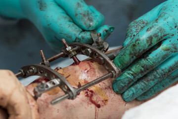 Surgeon sets a metal fixation system on a patient's shin close-up