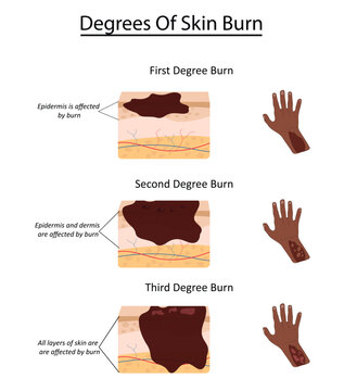 Degrees of skin burn vector illustration