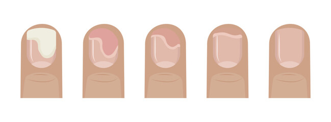 Stages of fingernail treatment showing onycholysis healing process