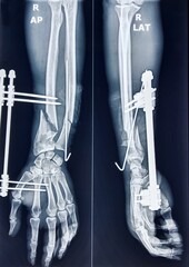 X ray image of right forearm antero-posterior and lateral view showing fracture at the lower end of...
