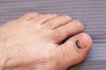 Damaged big toenail with signs of subungual hematoma or nail melanoma closeup