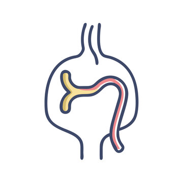 Endovascular Aneurysm Repair (EVAR) Procedure Graphic Illustration