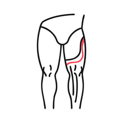 Iliotibial band syndrome diagram, IT band problem, vector
