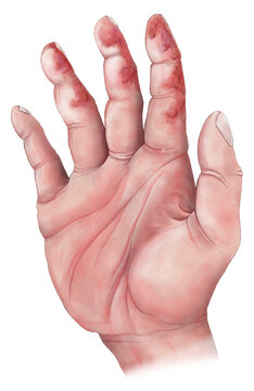 Superficial frostbite of a human hand, illustration