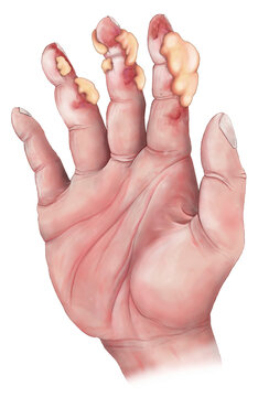 Moderate frostbite of a human hand, illustration