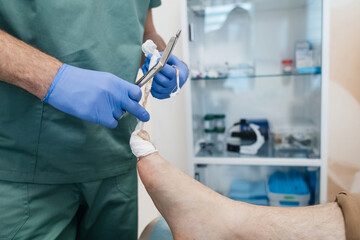 Resection of the nail plate, removal of ingrown nail. Dressing after surgery on the toe. Surgical treatment of onychocryptosis, paronychia and purulent disease