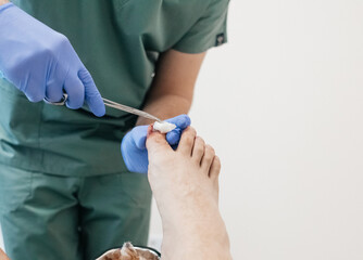 Resection of the nail plate, removal of ingrown nail. Dressing after surgery on the toe. Surgical...
