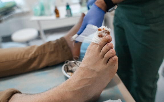Resection of the nail plate, removal of ingrown nail. Dressing after surgery on the toe. Surgical treatment of onychocryptosis, paronychia and purulent disease