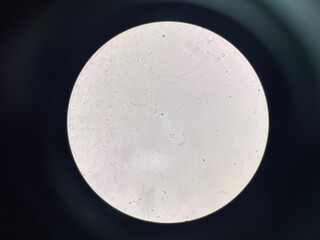 Calcium oxalate crystal in urine sediment.