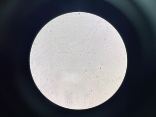 Calcium oxalate crystal in urine sediment.