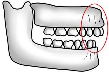 Abnormal jawbone structure with protruding upper jaw causing an overbite © sulari