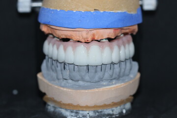 In dental implant surgery, the All-on-Four, All-on-4, and All-on-X treatments involve placing full-arch dental prostheses on cylindrical titanium implants applied to the upper jaw. Dental before after