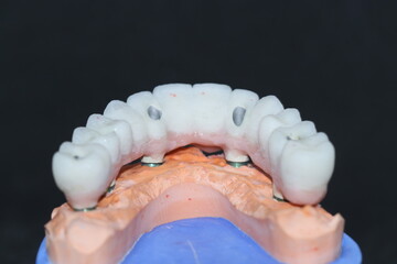 In dental implant surgery, the All-on-Four, All-on-4, and All-on-X treatments involve placing full-arch dental prostheses on cylindrical titanium implants applied to the upper jaw. Dental before after