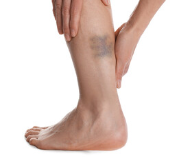 Woman with bruise on leg against white background, closeup