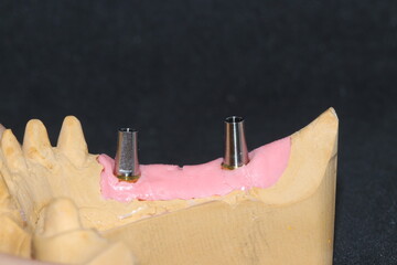 Prosthetic tooth treatment with intraosseous dental implants via jaw surgery in dental dentistry. Tooth loss implant treatment. Smile makeover.  © UniqDream