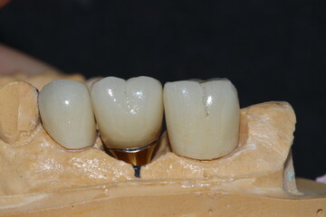 Prosthetic tooth treatment with intraosseous dental implants via jaw surgery in dental dentistry. Tooth loss implant treatment. Smile makeover.  © UniqDream