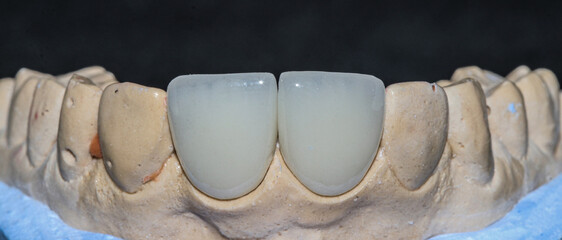 Glass ceramic or zirconium porcelain crowns. Dental bridge crown treatment. Aesthetic smile design treatment in dental dentistry.  Dental Laminate veneers, smile design.   © UniqDream