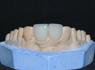 Glass ceramic or zirconium porcelain crowns. Dental bridge crown treatment. Aesthetic smile design treatment in dental dentistry.  Dental Laminate veneers, smile design. 

