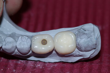 Prosthetic tooth treatment with intraosseous dental implants via jaw surgery in dental dentistry. Tooth loss implant treatment. Smile makeover.  © UniqDream