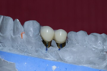 Prosthetic tooth treatment with intraosseous dental implants via jaw surgery in dental dentistry. Tooth loss implant treatment. Smile makeover.  © UniqDream