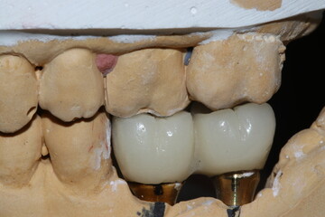 Prosthetic tooth treatment with intraosseous dental implants via jaw surgery in dental dentistry. Tooth loss implant treatment. Smile makeover.  © UniqDream