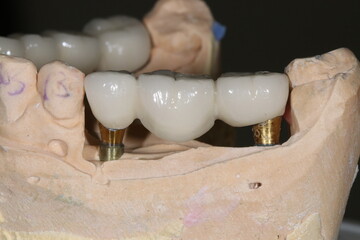 Prosthetic tooth treatment with intraosseous dental implants via jaw surgery in dental dentistry. Tooth loss implant treatment. Smile makeover.  © UniqDream