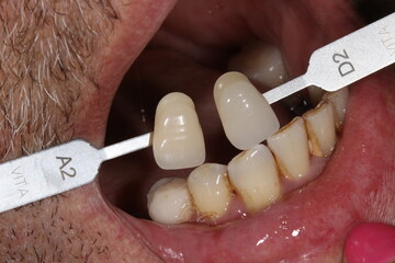 Glass ceramic or zirconium porcelain crowns. Dental bridge crown treatment. Aesthetic smile design treatment in dental dentistry.  Dental Laminate veneers, smile design.   © UniqDream