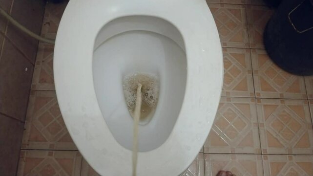 Urine. Urinating into the toilet. Foamy urine.