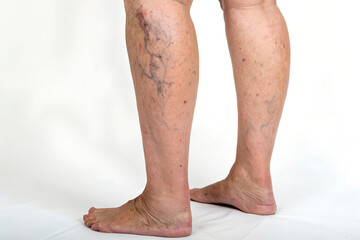 varicose veins of the legs