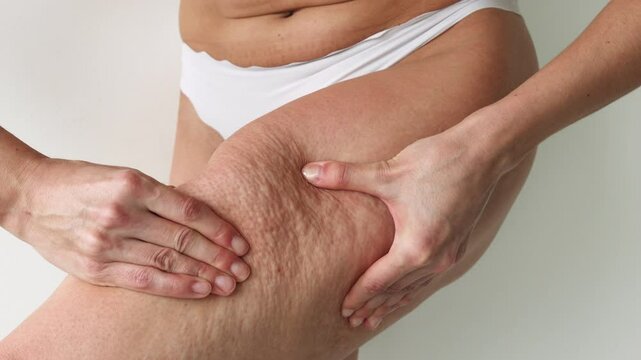 Close-Up of Woman's Thigh with Stretch Marks and Cellulite, Body Care, Skin Health, and Self-Acceptance Concept
