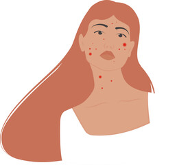 Girl with acne, problem skin concept. Cartoon scene skin problem isolated on white background