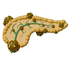 Medical and health science 3d icon. Pancreatic cancer cells spreading through pancreas and pancreatic duct.