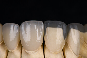 before and after picture of dental treatment by implants crowns and venners