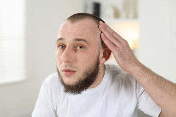 Fototapeta premium Baldness problem. Man with receding hairline at home