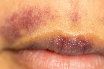 Background image of wounds caused by Systemic Lupus erythematosus (SLE) or Lupus.