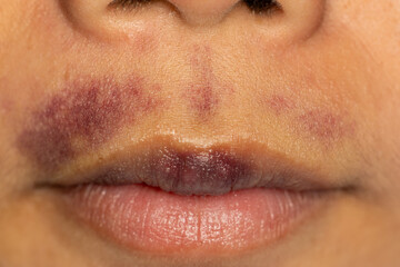 Background image of wounds caused by Systemic Lupus erythematosus (SLE) or Lupus.