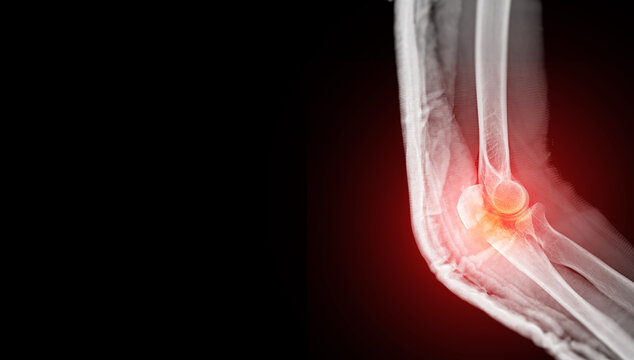 An X-ray image showing a fracture of the olecranon process of the ulna, highlighted by the red area indicating swelling and inflammation.